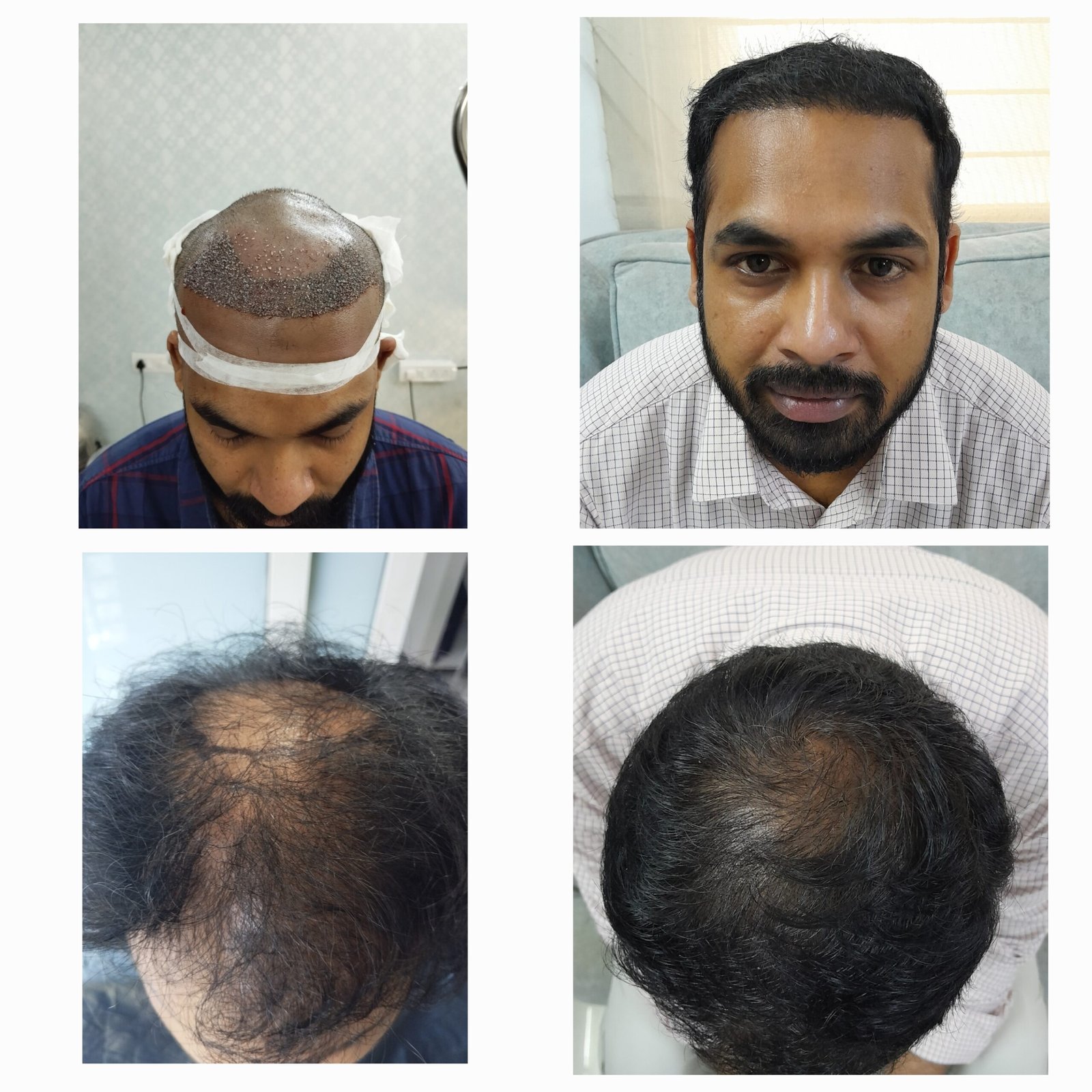 Hair transplant result