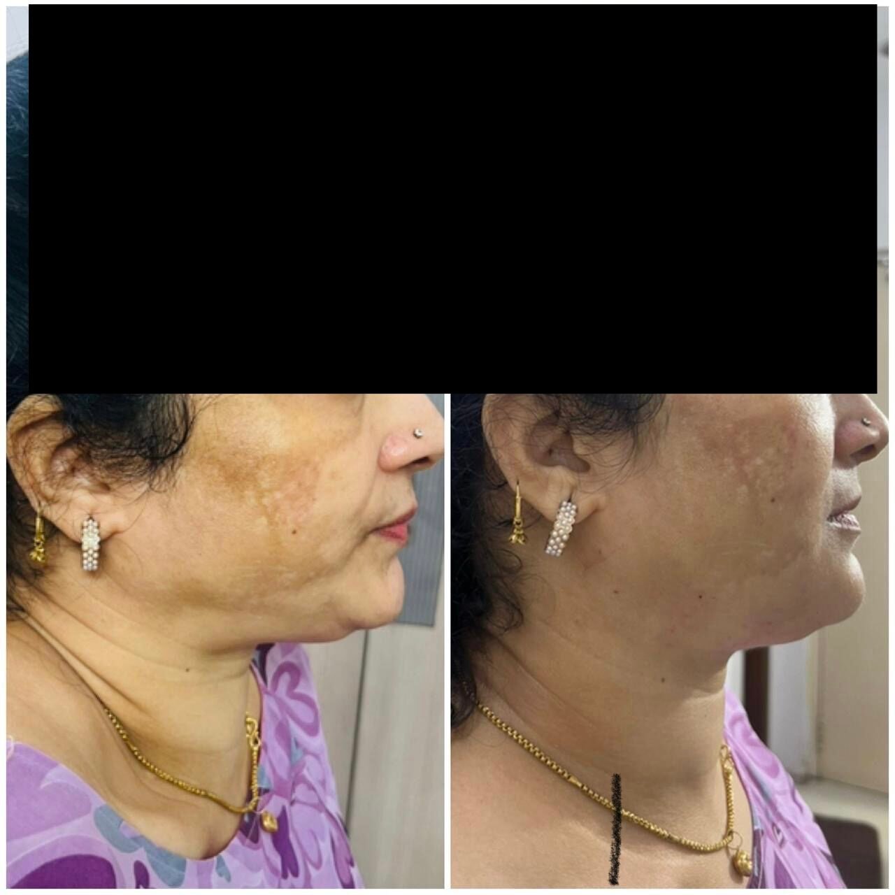Skin tightening result