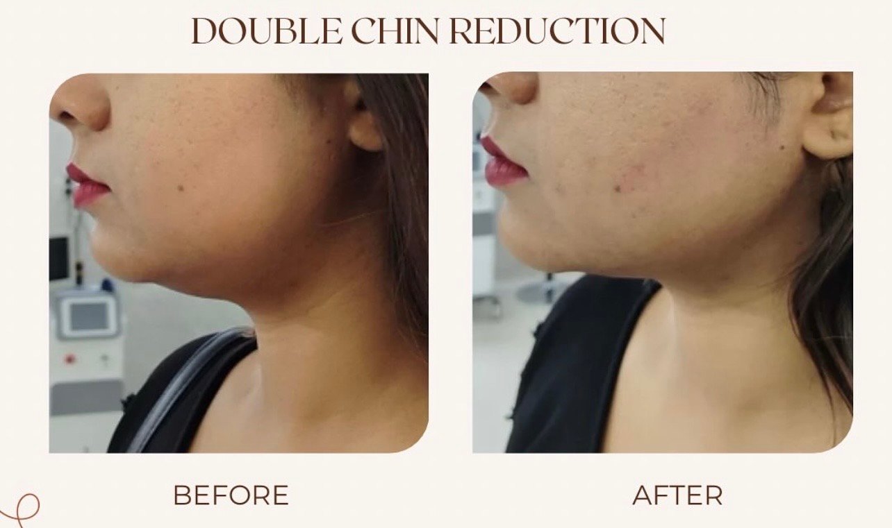 Double chin result