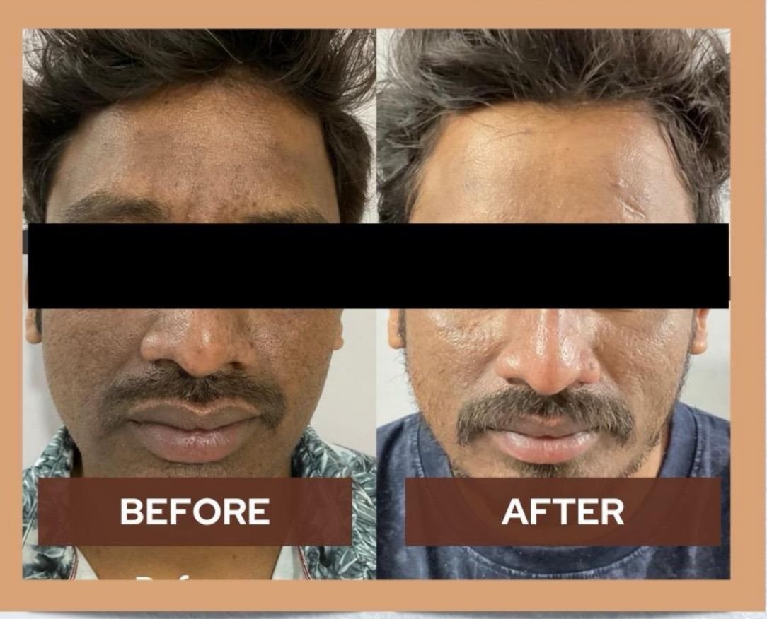 Pigmentation result
