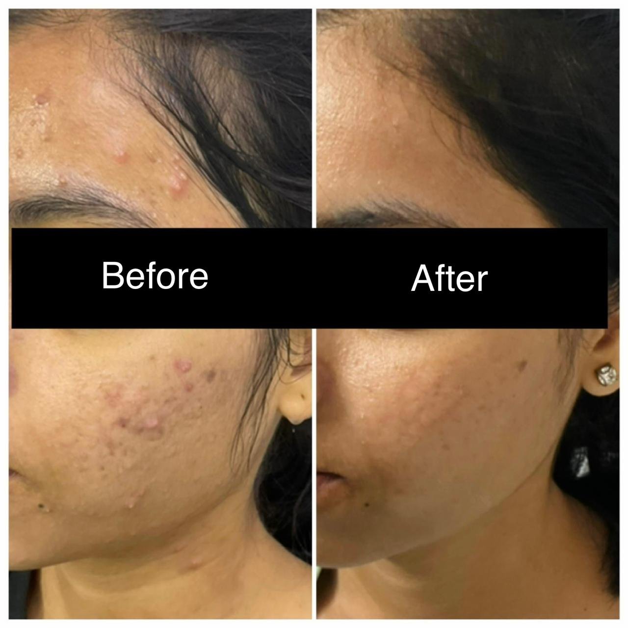 Acne result