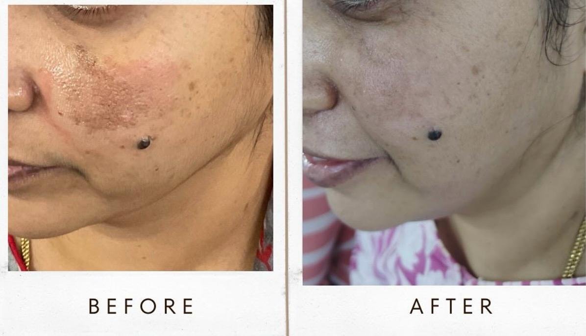 Melasma result